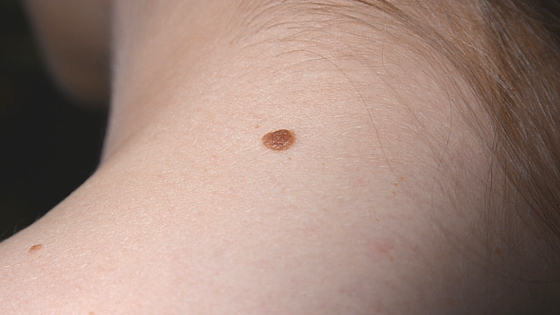 Muttermale entfernen lassen: Welche Methoden gibt es? 2 erhabenes20Muttermal1
