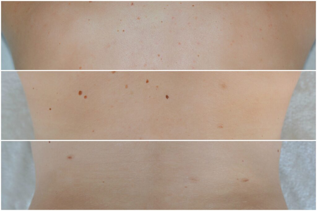 Update: Muttermale lasern I So sieht’s nach 2 Jahren aus 3 muttermal update 101