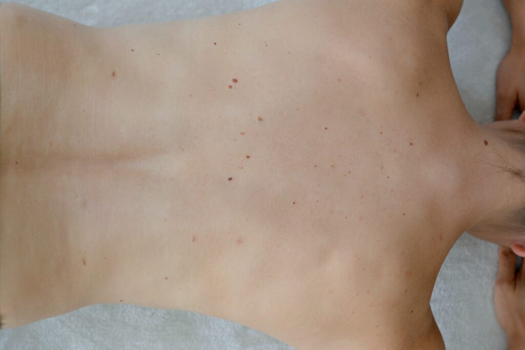 Update: Muttermale lasern I So sieht’s nach 2 Jahren aus 1 muttermal update 21