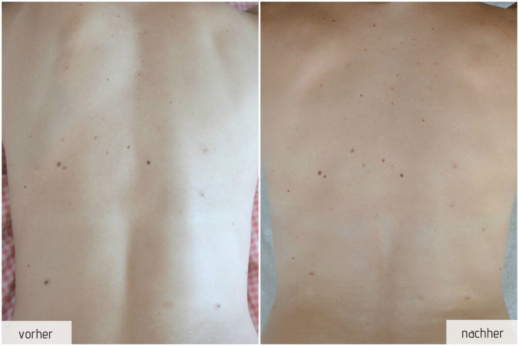 Update: Muttermale lasern I So sieht’s nach 2 Jahren aus 2 muttermal update 91